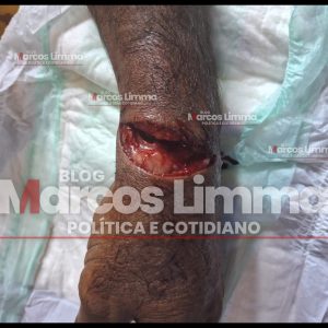 Homem é ferido com golpe de facão no braço ao tentar defender a mãe do seu próprio irmão, na zona rural de Lima Campos