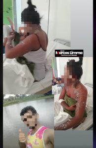 Em Capinzal do Norte mulher sofre queimaduras pelo corpo após companheiro jogar gasolina e atear fogo